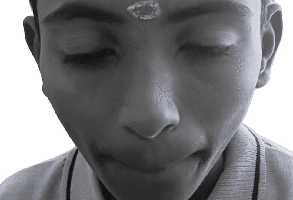 Involuntary Facial Movements with Elevated ASLO Titres in a Child