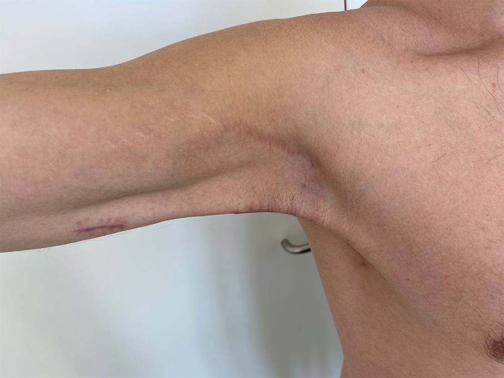 Unveiling m. pectoralis quartus: clinical and anatomical insights