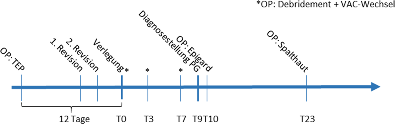 Pyoderma gangraenosum nach Implantation einer inversen Schultertotalendoprothese