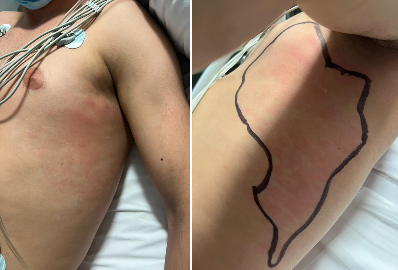 Necrotizing fasciitis vs. streptococcal myositis in a manual worker: a case report