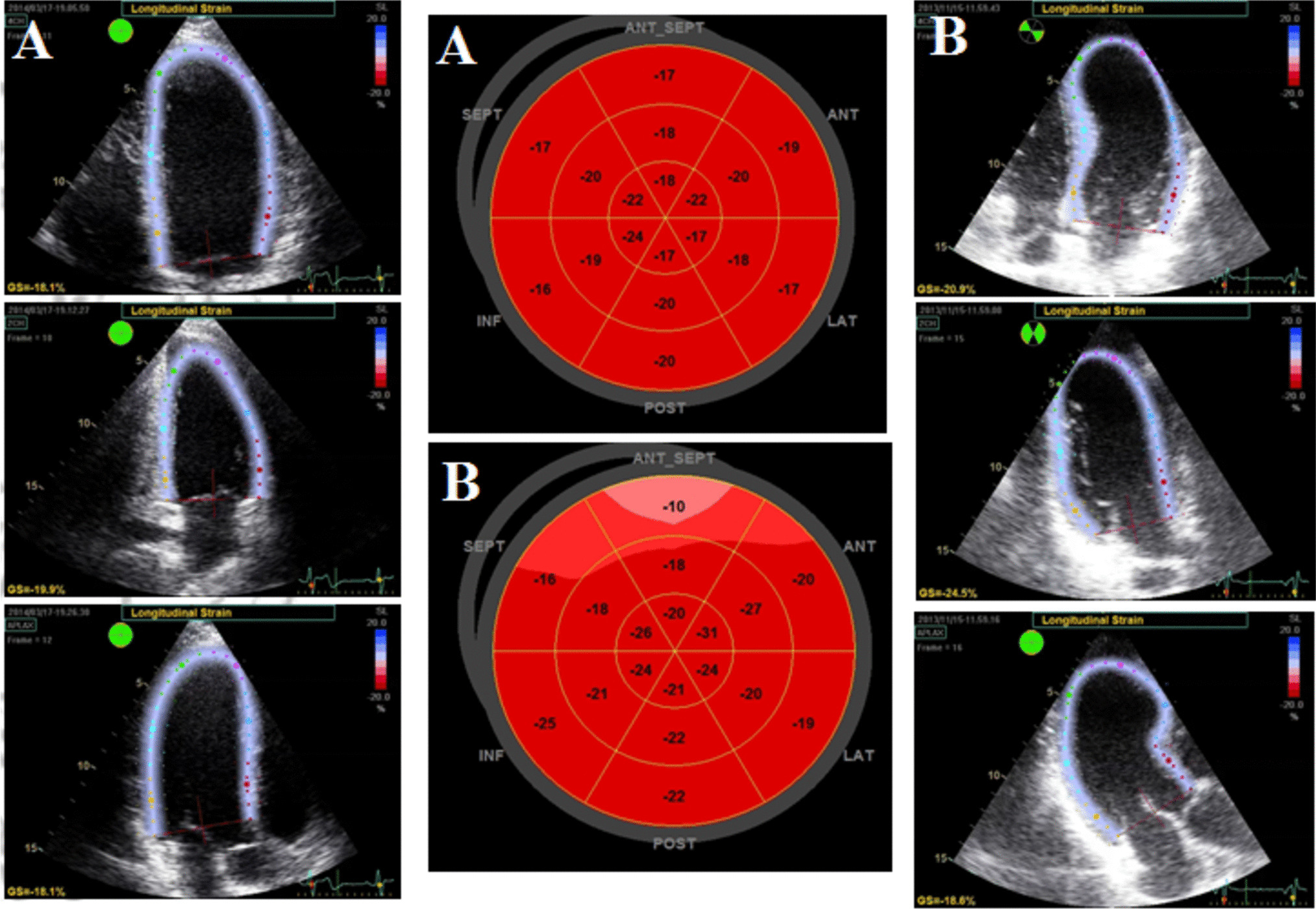 A concise guide of contemporary cardiovascular imaging practices to differentiate athlete’s heart in the gray zone