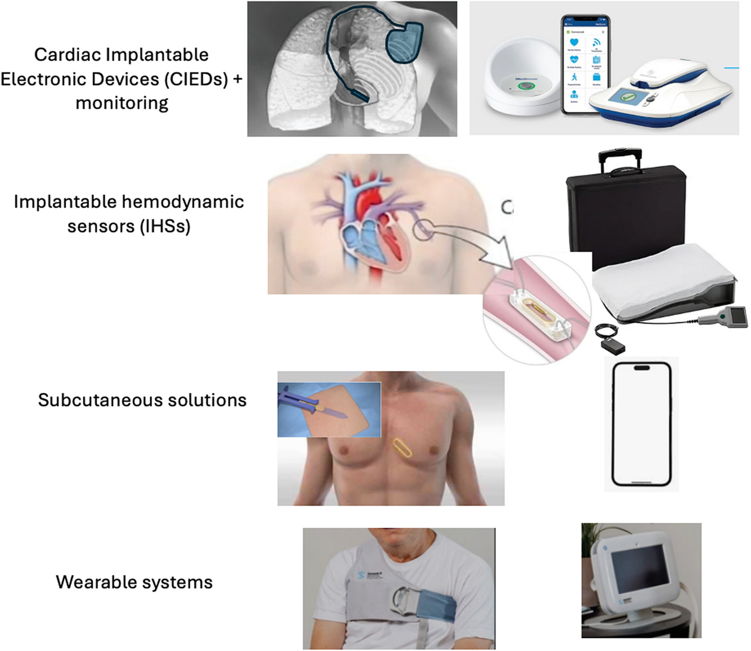 Subcutaneous sensors for monitoring congestion and to reduce heart failure hospitalizations—a viable middle ground between deep implantable intravascular monitoring devices and wearable technologies?