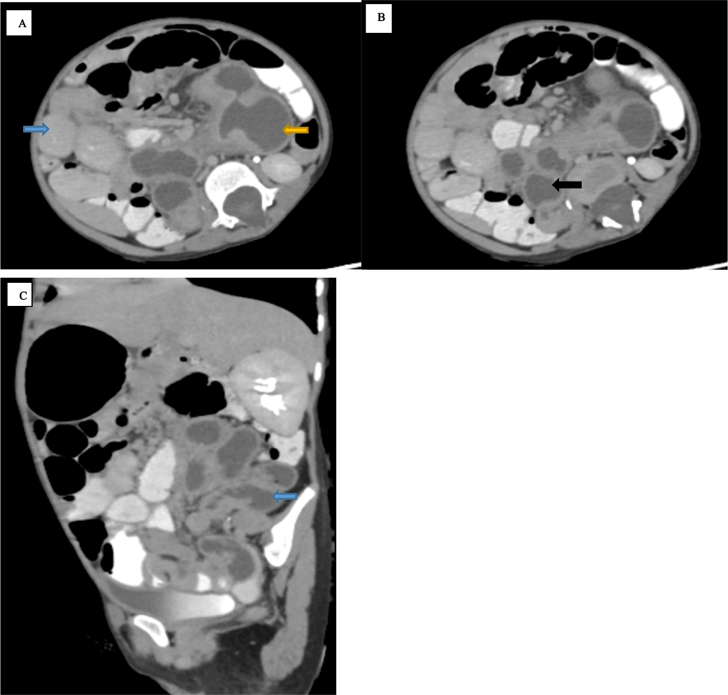 Case report: a rare cause of chronic abdominal pain and failure to thrive in a child — extensive gastrointestinal tract duplication cyst