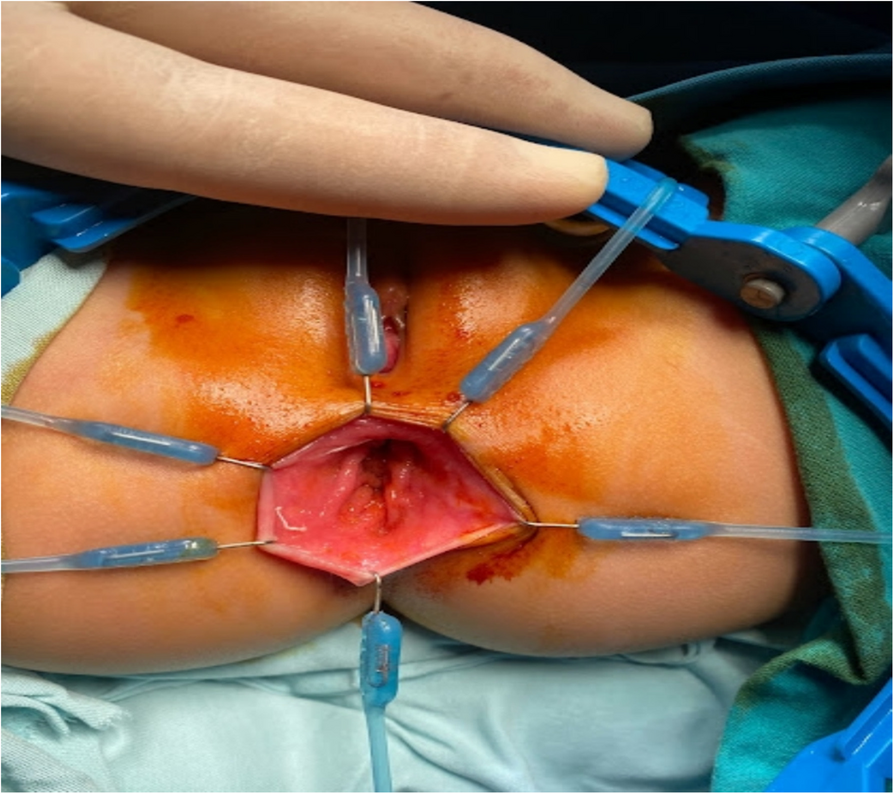 Effect of concomitant use of hypertonic saline injection with anal cerclage for treatment of idiopathic partial rectal prolapse in children: a double hit therapy