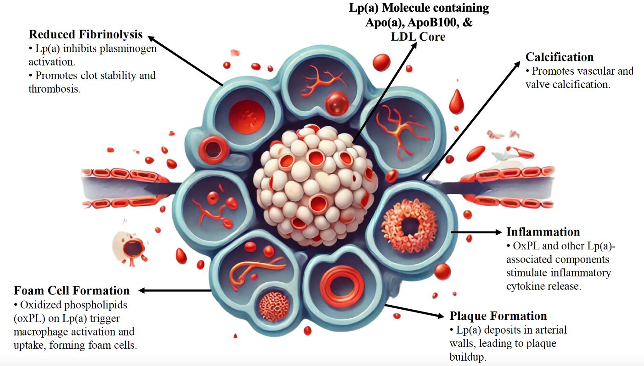 Clinical Update on the Intersection of Lipoprotein(a) and Calcific Valve Disease