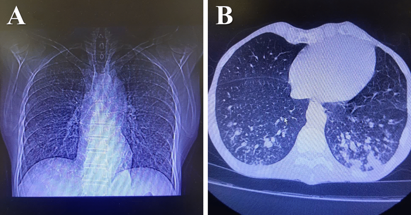MicroRNA-27a gene polymorphism (rs895819) association with risk of pulmonary tuberculosis (PTB): A case–control study