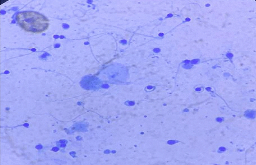 Homozygous deletion of the DPY19L2 gene as a major genetic cause of globozoospermia: a case report from Senegal