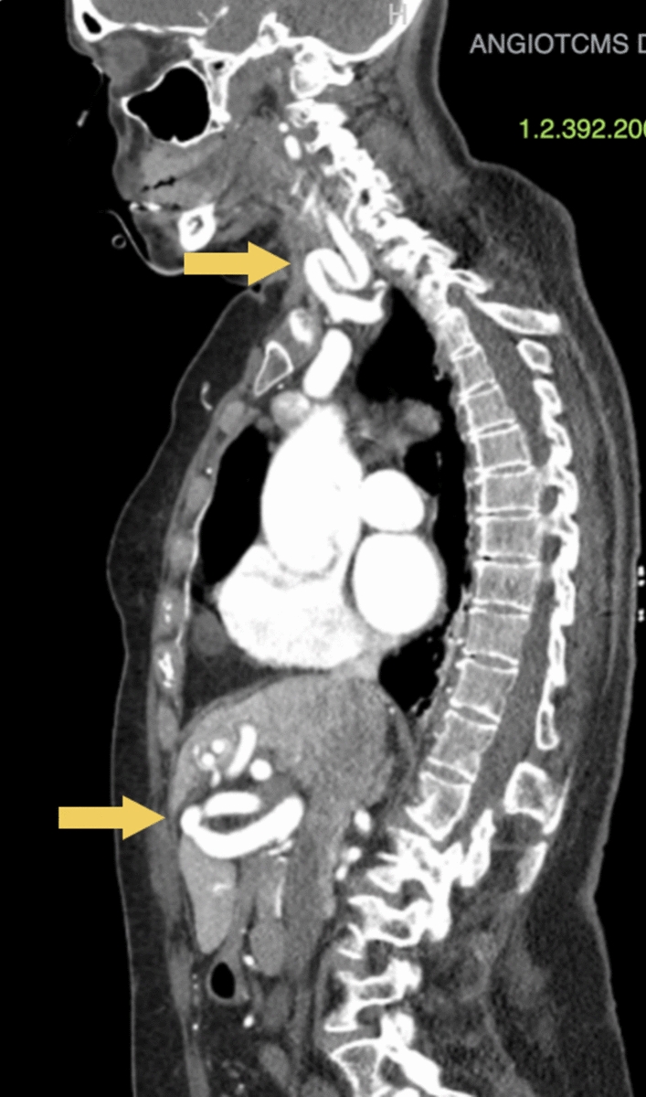 Acute aortic dissection in a patient with Hereditary Hemorrhagic Telangiectasia associated with Juvenile Polyposis due to SMAD4 mutation: case report and literature review