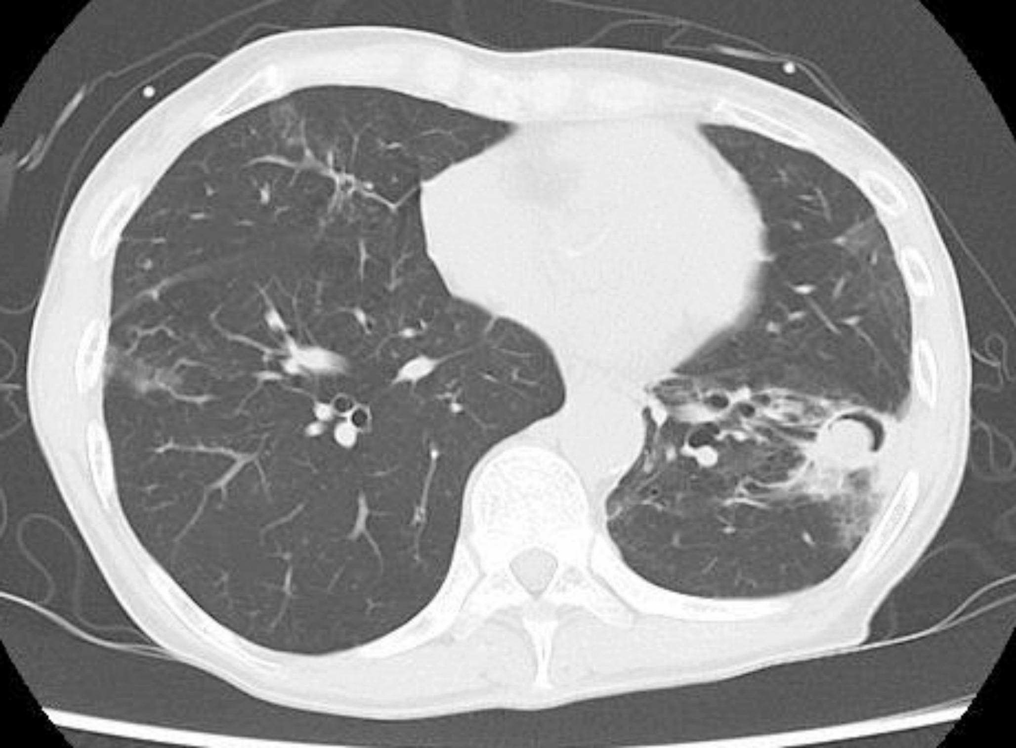 Pulmonary fungus ball due to  mimicking aspergilloma: a case report
