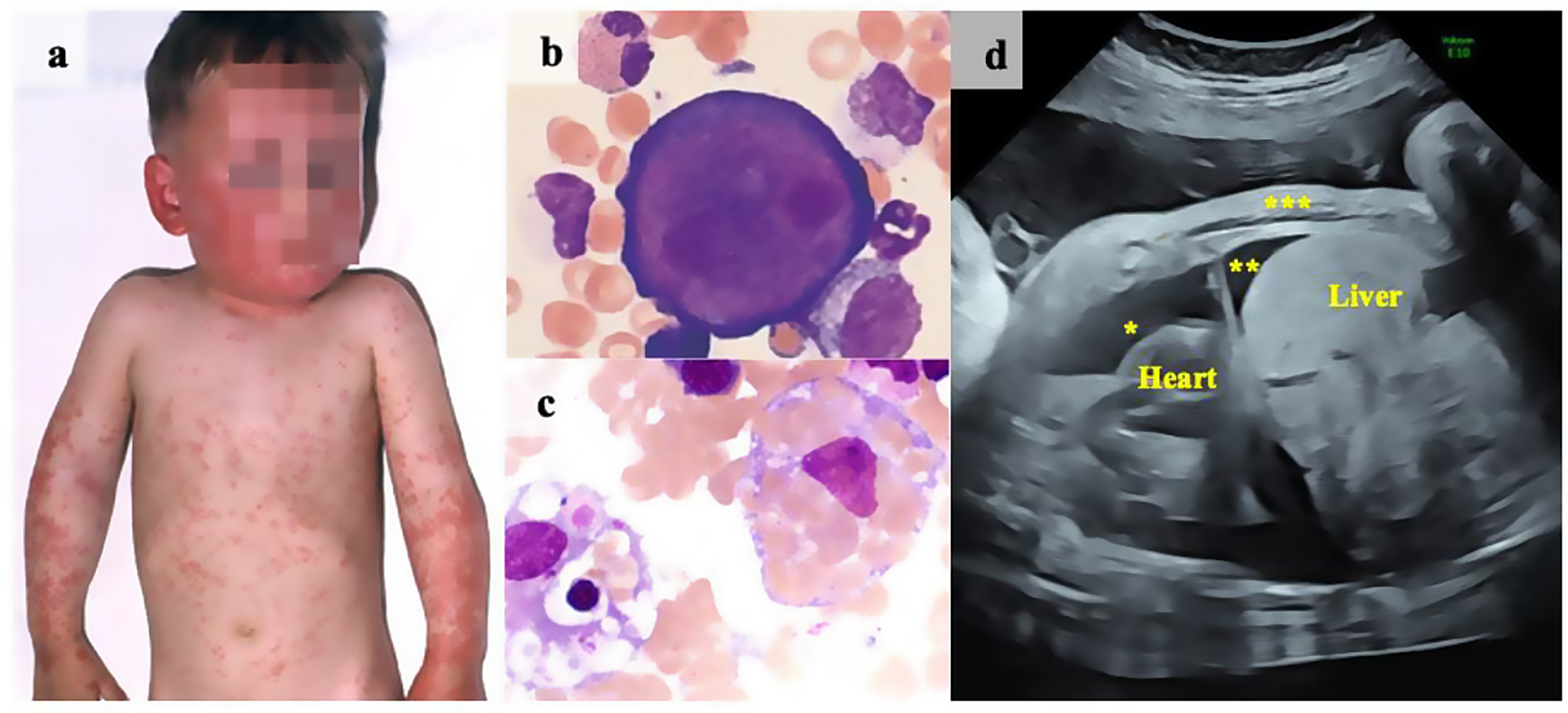 Diverse clinical manifestations of Parvovirus B19 infections during the 2024 outbreak in Germany