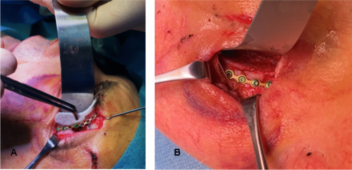 Evaluation of Ultra-High Molecular Weight Polyethylene (UHMWPE) Implants in Orbital Fracture Reconstruction: A Multicenter Cohort Study