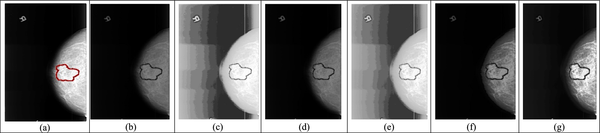 A metaheuristic-based histogram equalization method for mammogram enhancement using a brightness preserving cuckoo search algorithm