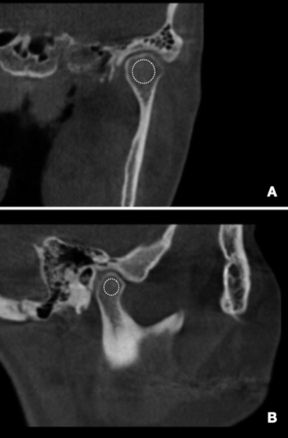 Fractal analysis of the mandibular ramus in class II and III patients undergoing orthognathic surgery: retrospective study trough cone-beam computed tomography