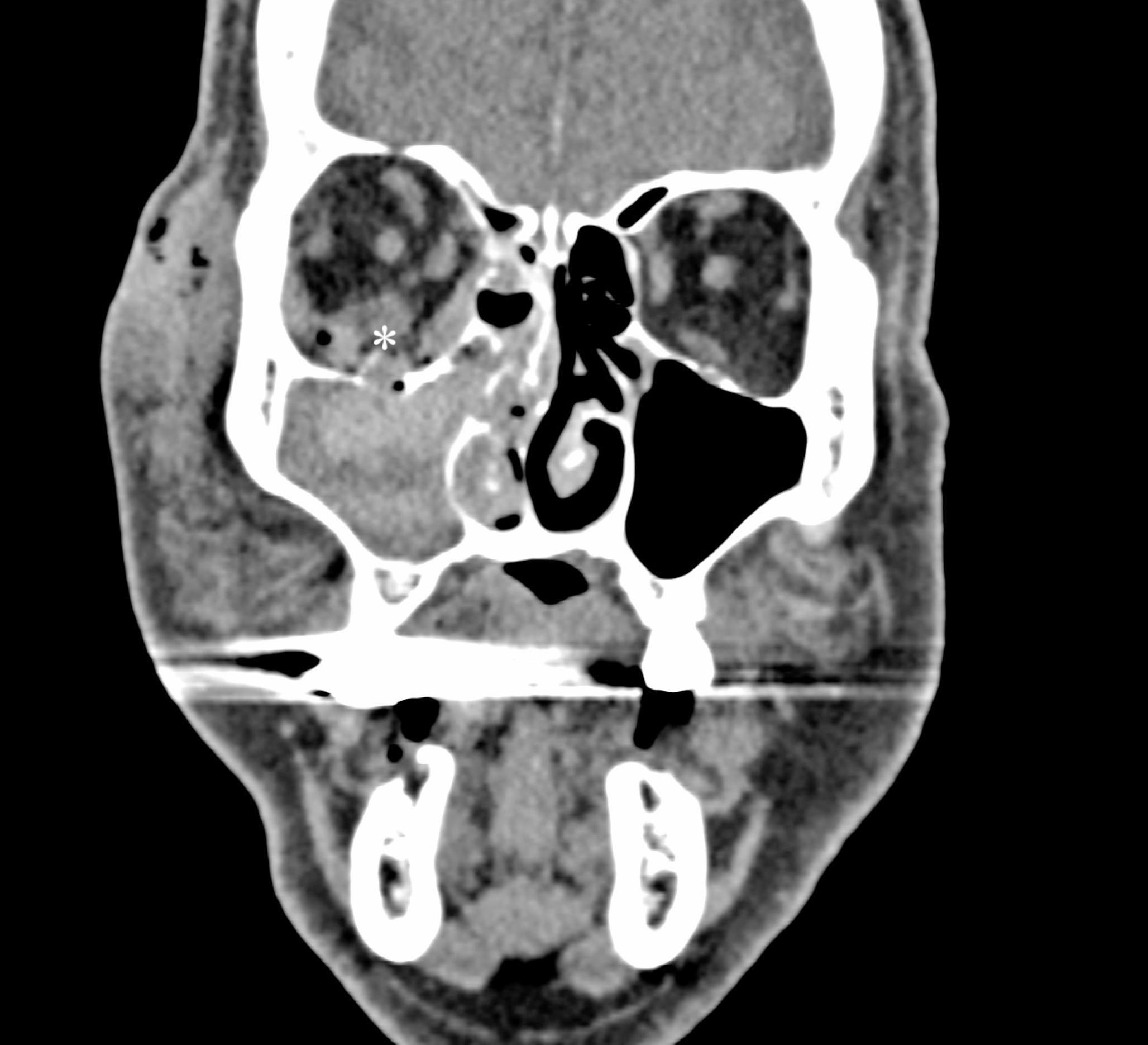Occurrence and outcomes of retrobulbar haematoma in 2149 orbital fracture patients