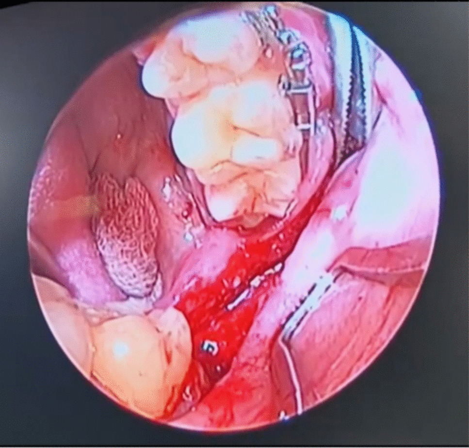 Advancing precision in bilateral sagittal split osteotomy: a pioneering perspective on minimizing inferior alveolar nerve injury through endoscopic visualization