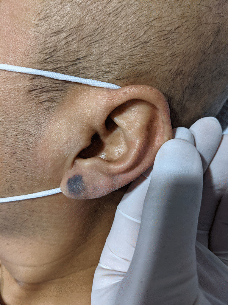 Exogenous Skin Lesions in the Intensive Care Unit: Recognition, Management, and Prevention Strategies