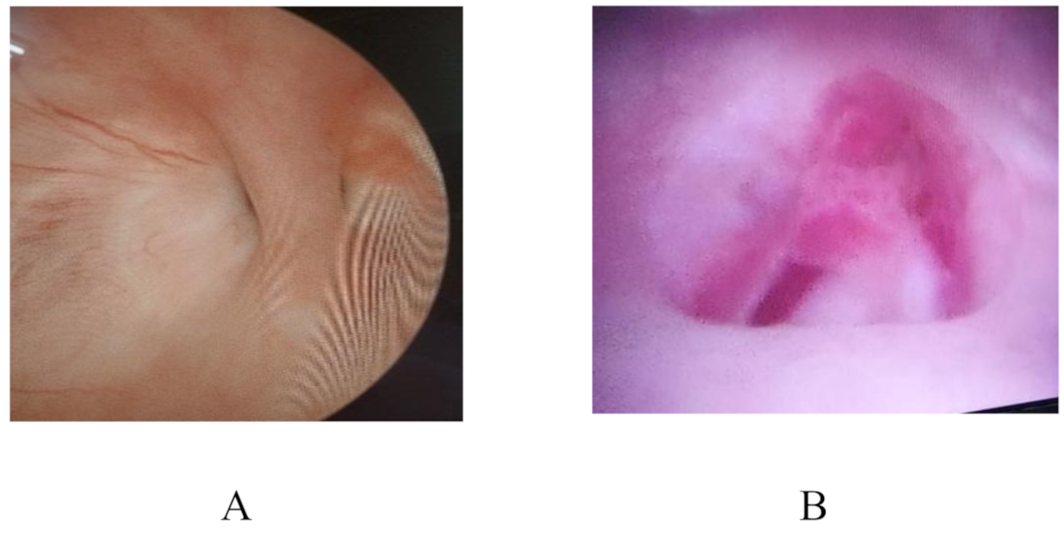 Inter-positional Peritoneal Flap in Vesico-uterine Fistula Repair: Single Academic Center Experience