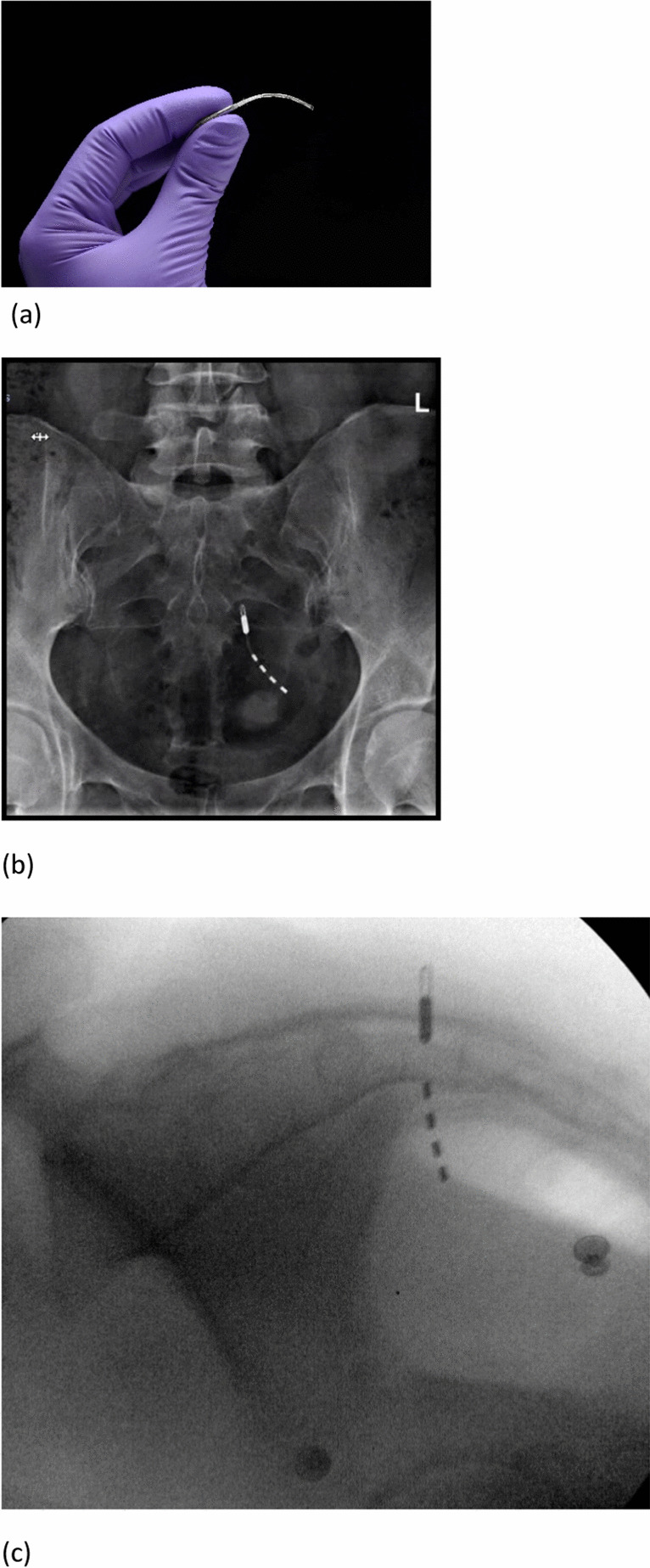 Sacral Neuromodulation Without an Implanted Battery