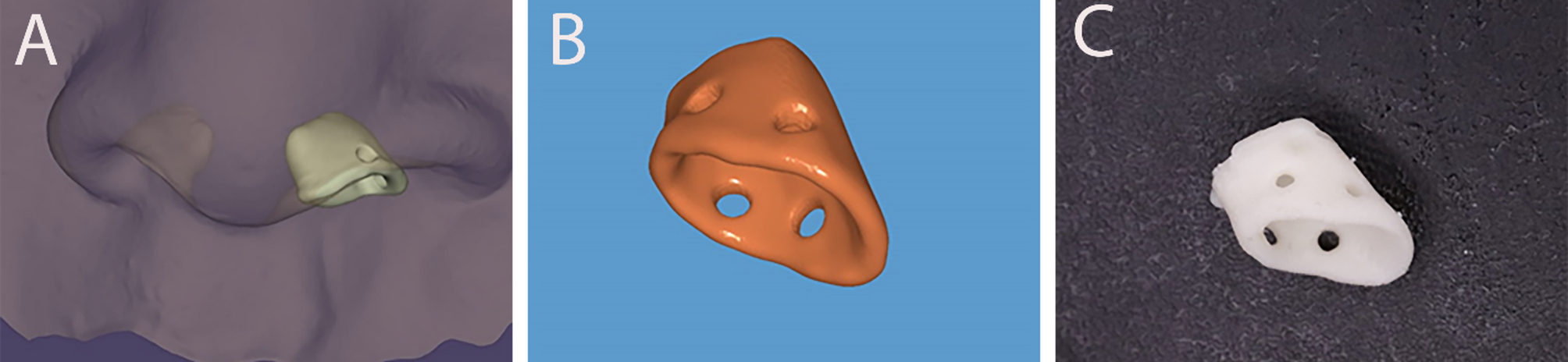 Assessment of symmetry and parental satisfaction after use of customized nasal conformers in unilateral cleft lip repair: a randomized controlled clinical trial