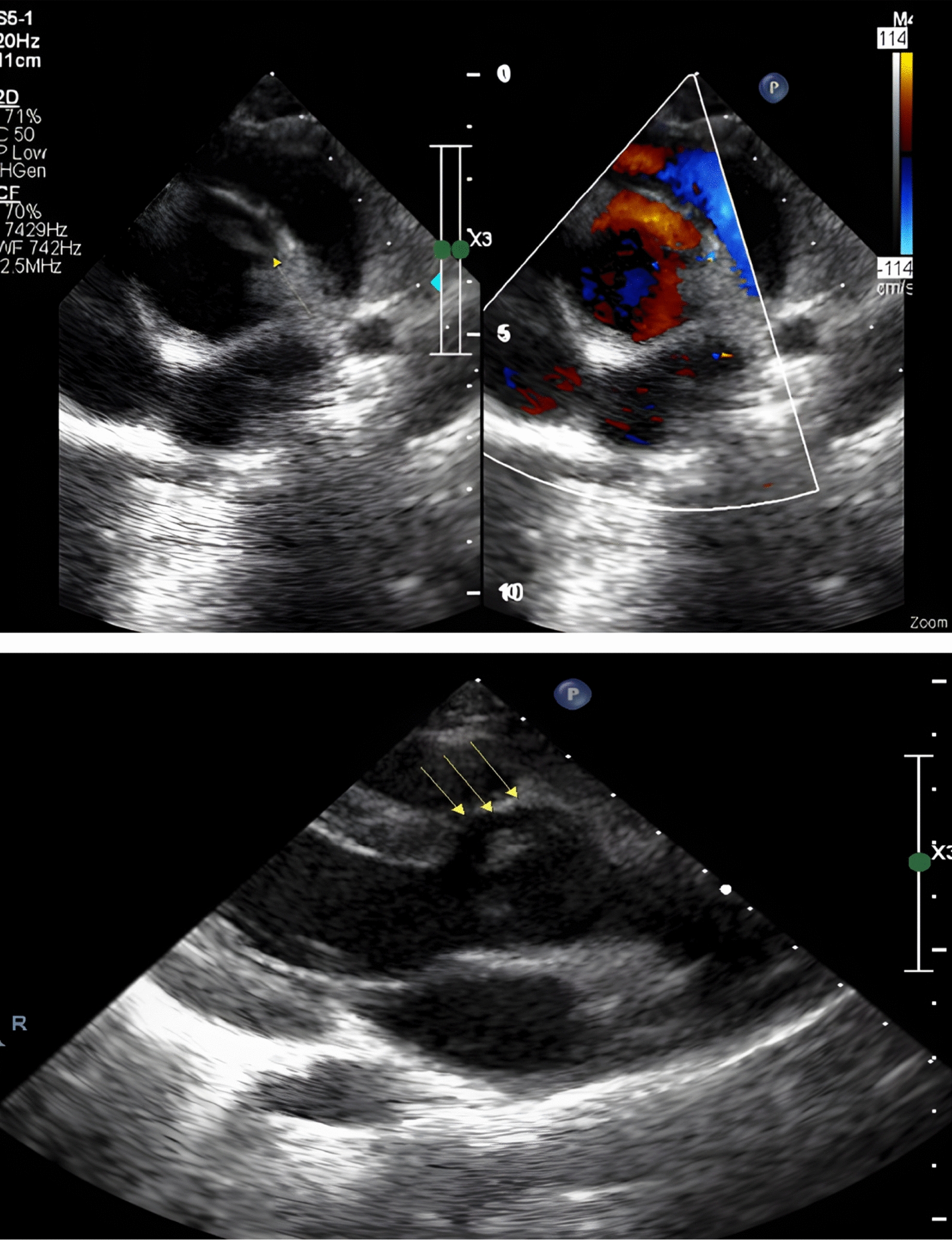 A report study of successful surgical treatment of an aorto-left ventricular tunnel in a 5-year-old boy: differential diagnosis from other congenital heart diseases with similar clinical symptoms