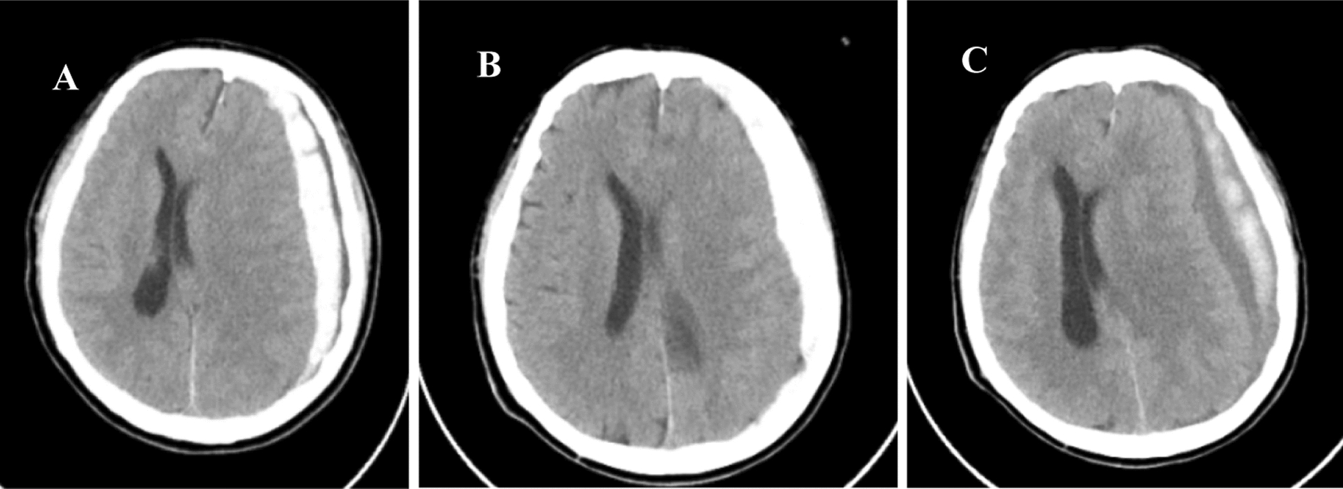 Extensive subdural hematoma and brain herniation following spine surgery: a case report