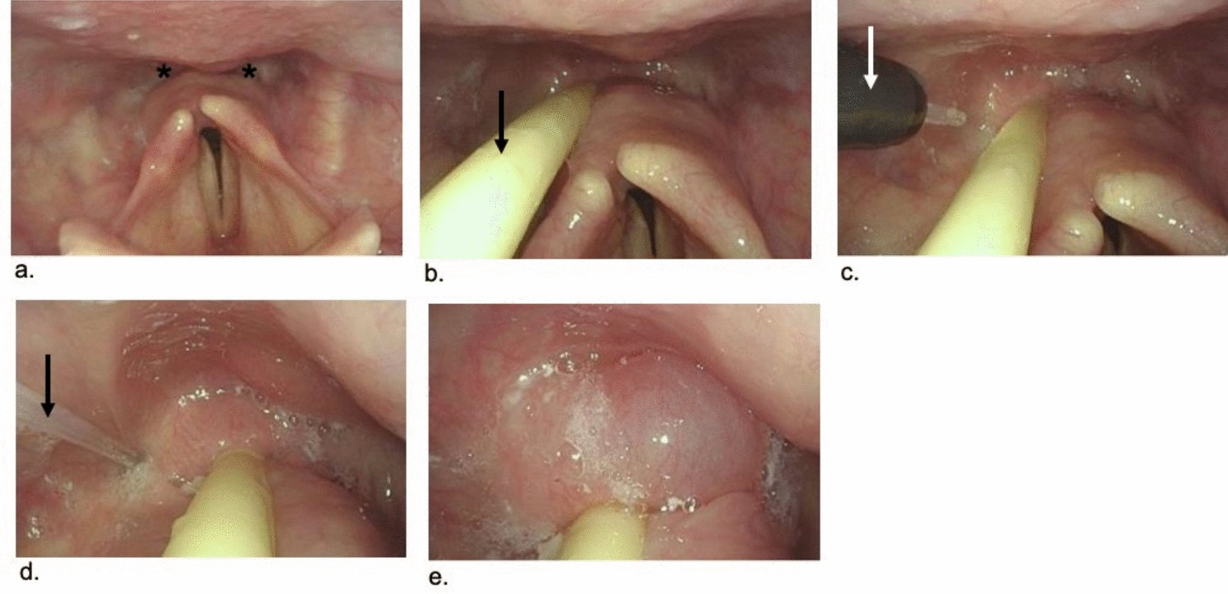 The Effectiveness of Botulinum Toxin Injection for Cricopharyngeal Dysfunction-Related Dysphagia in Nasopharyngeal Carcinoma Patients