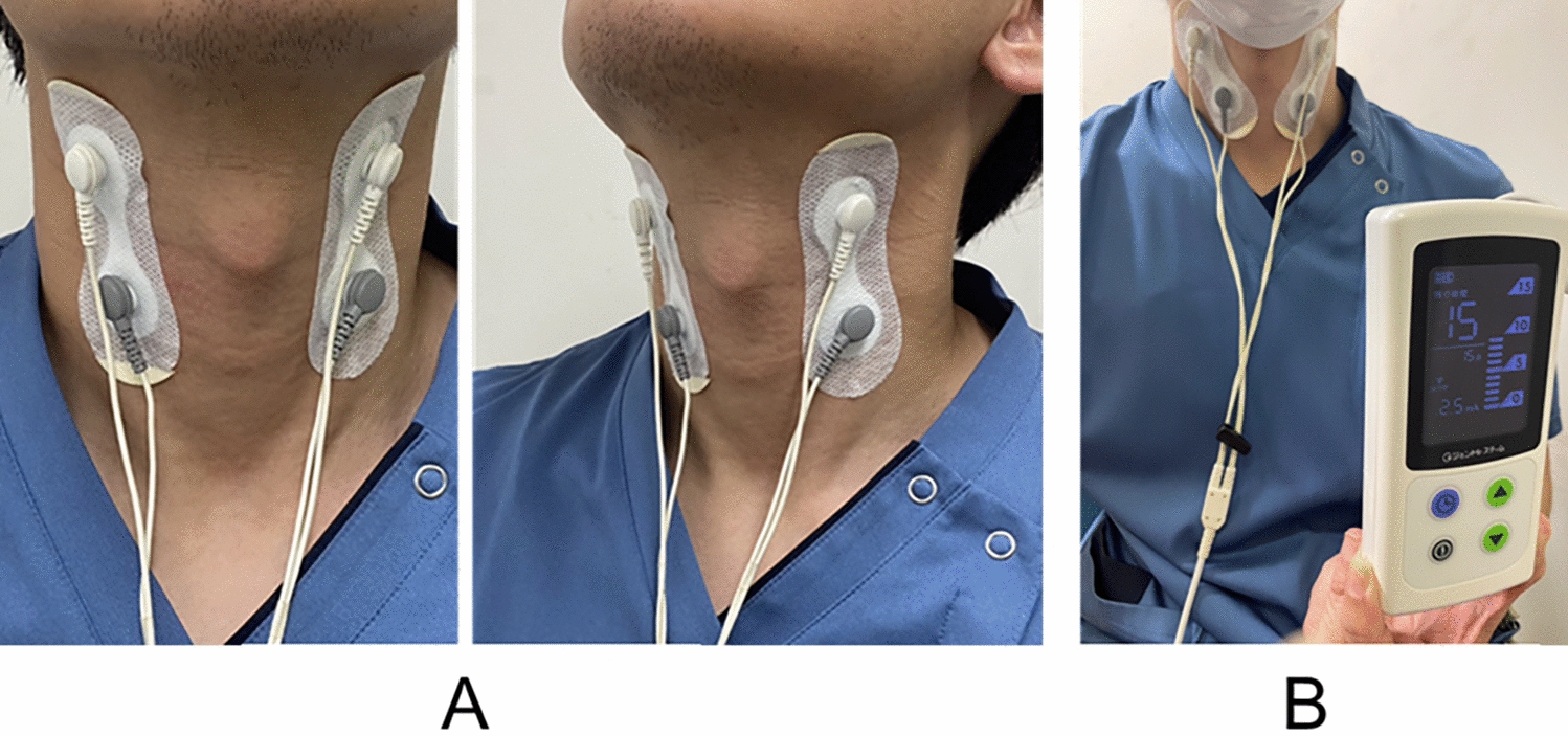 Effects of Active Interferential Current Stimulation on Swallowing Function in Patients with Dysphagia: A Cross-Sectional Study of Interferential Current Stimulation on Swallowing Function in Patients with Dysphagia: A Cross-Sectional Study