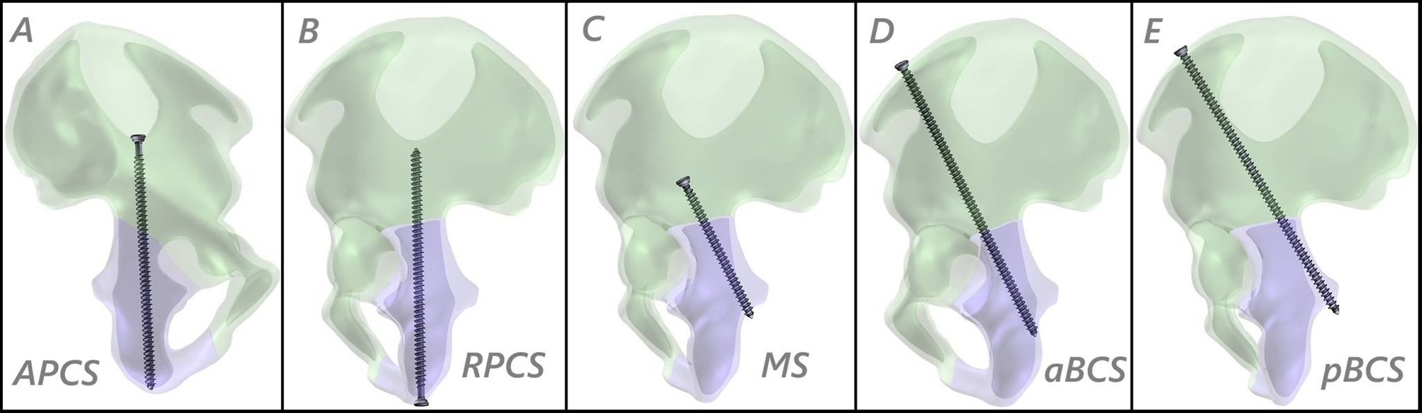 Is the innovative both column screw fixation technique a biomechanical game-changer in the fixation of acetabular posterior column fractures?