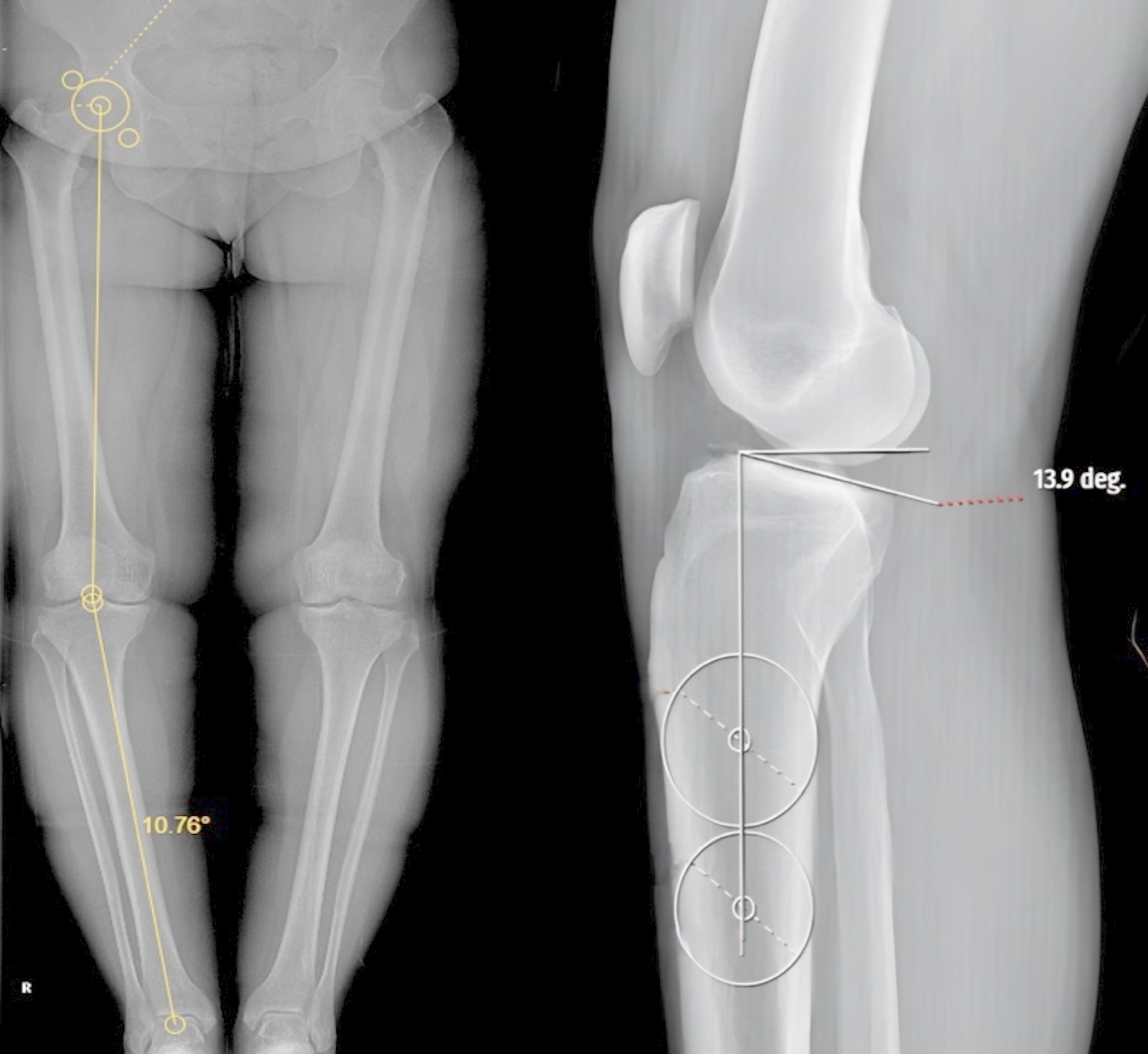 Does pes anserinus release affect outcomes in medial open wedge high tibial osteotomy?