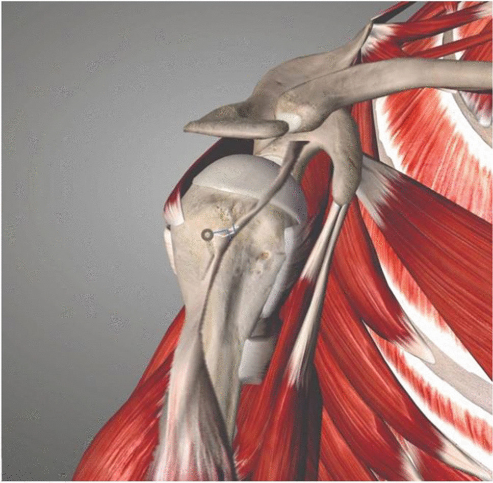 Superior Capsular Reconstruction Using the Long Head of the Biceps Tendon for Large to Massive Rotator Cuff Tears with Pseudoparalysis: A Prospective Clinical Study