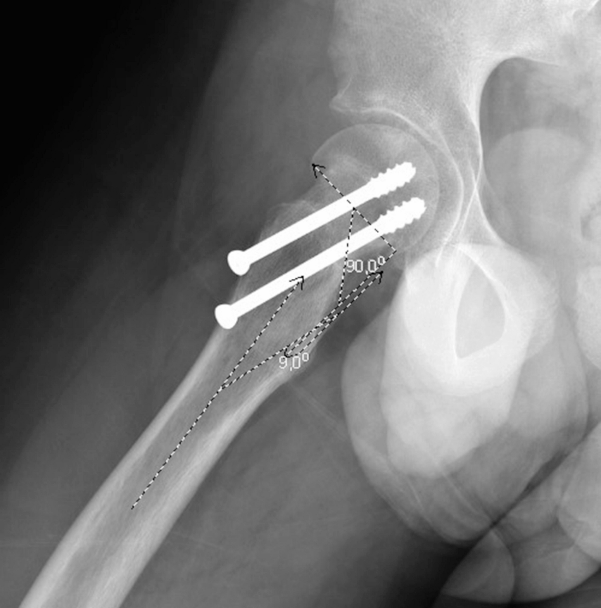 Radiological outcome and complications after subcapital shortening osteotomy for the treatment of slipped capital femoral epiphysis– a case series–