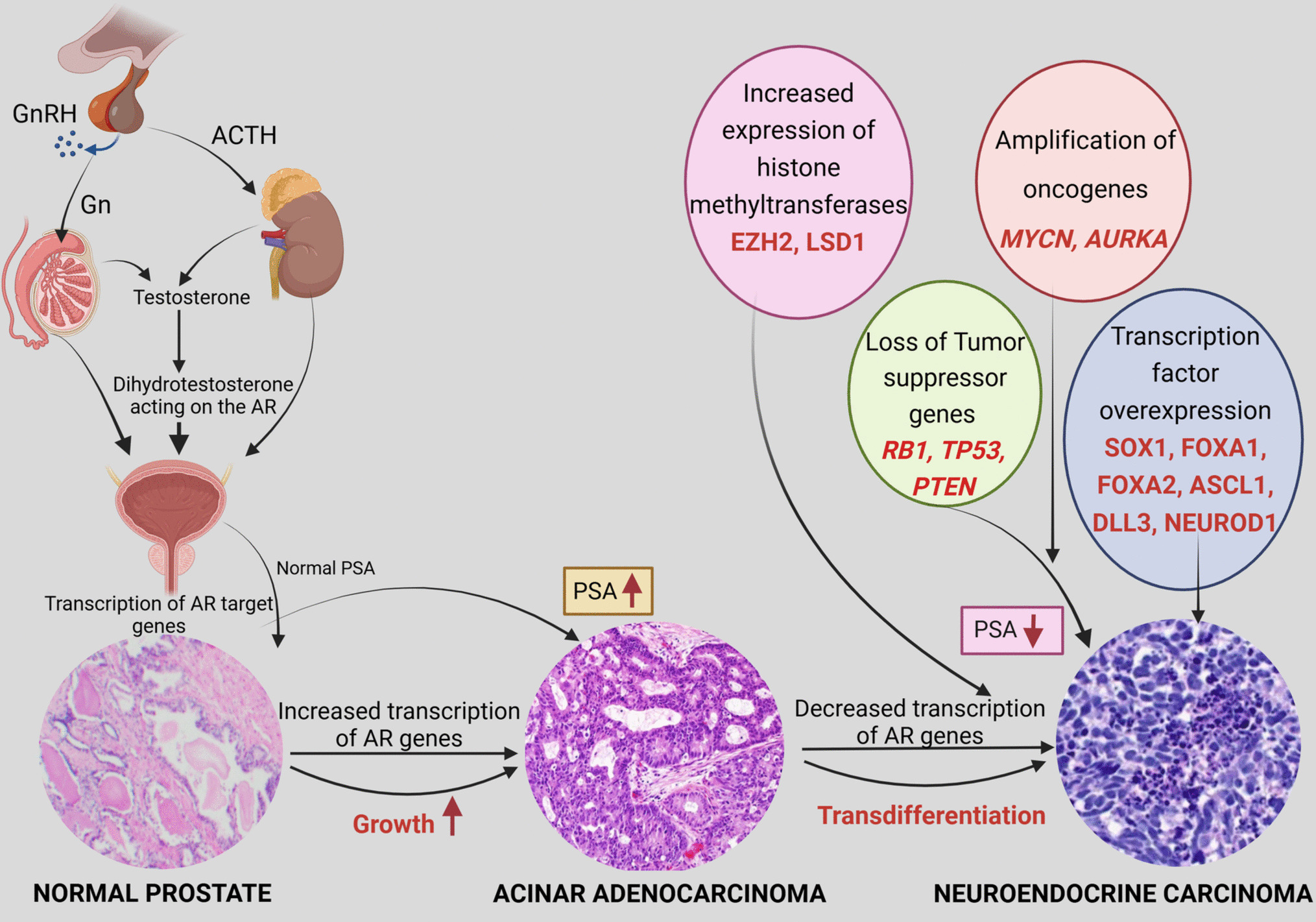 Reappraisal of Neuroendocrine Tumor Classification of the Prostate Gland: Translating Molecular Insights into Clinical Practice
