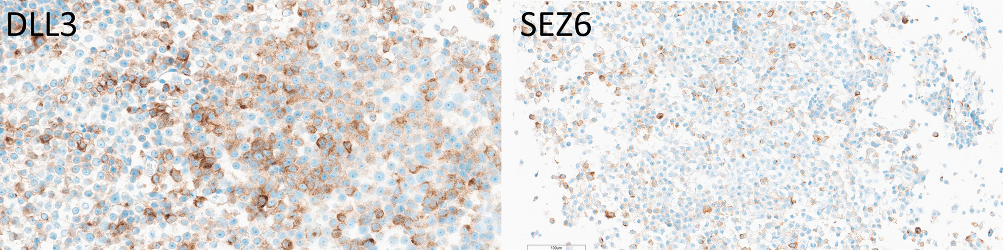 Expression of DLL3 and SEZ6 in the Spectrum of Neuroendocrine Neoplasia