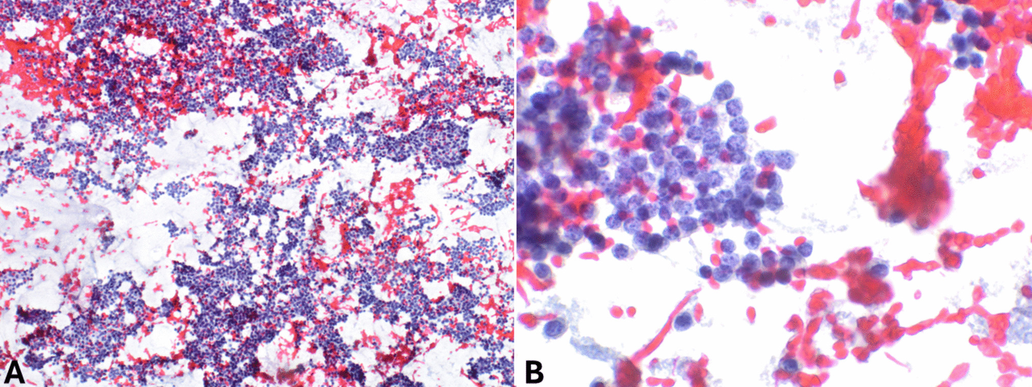 Roadmap to Challenges in Limited Cellularity Specimens from Pancreatic Neuroendocrine Neoplasms: Diagnostic Tools for the Most Appropriate Management of Limited Material