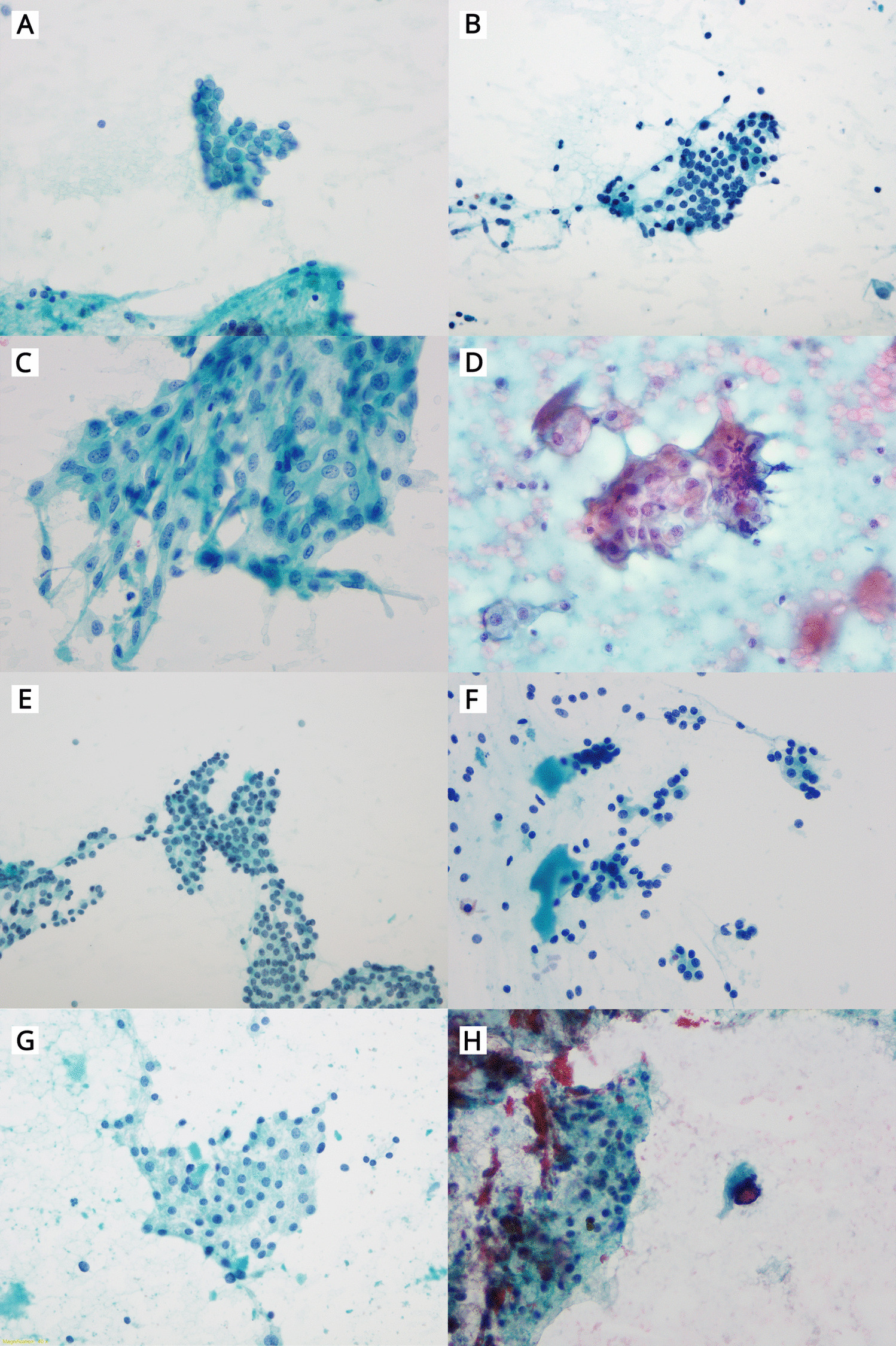 Subclassifying "Atypia of Undetermined Significance (AUS)" Category in the 2023 Bethesda System for Thyroid Cytopathology: Analyzing K-TIRADS,  V600E Mutation, and Risk of Malignancy