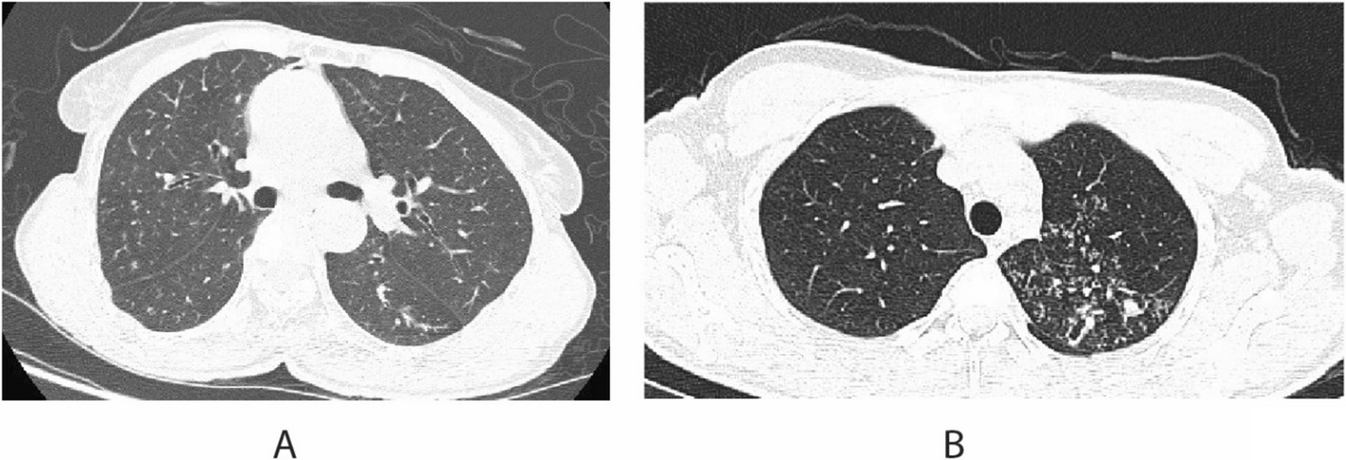 Bronchiectasis and Non-Tuberculous Mycobacteria Infection: Who Needs Treatment?