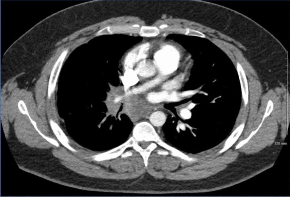 Fibrosing Mediastinitis