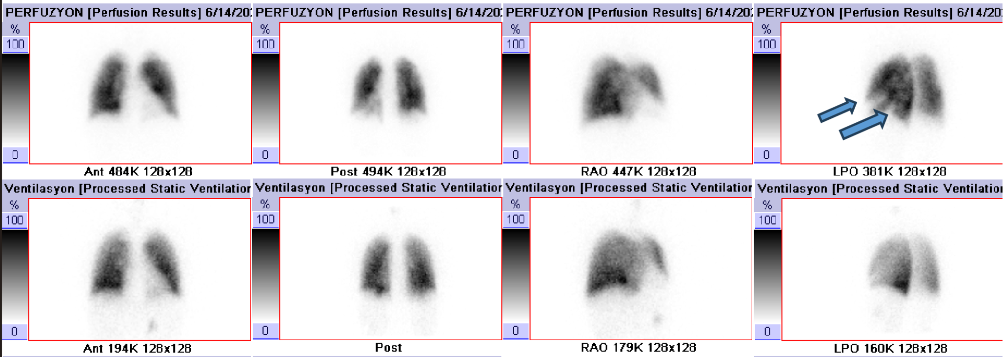 The role of ventilation/perfusion scintigraphy in distinguishing acute from chronic pulmonary embolism