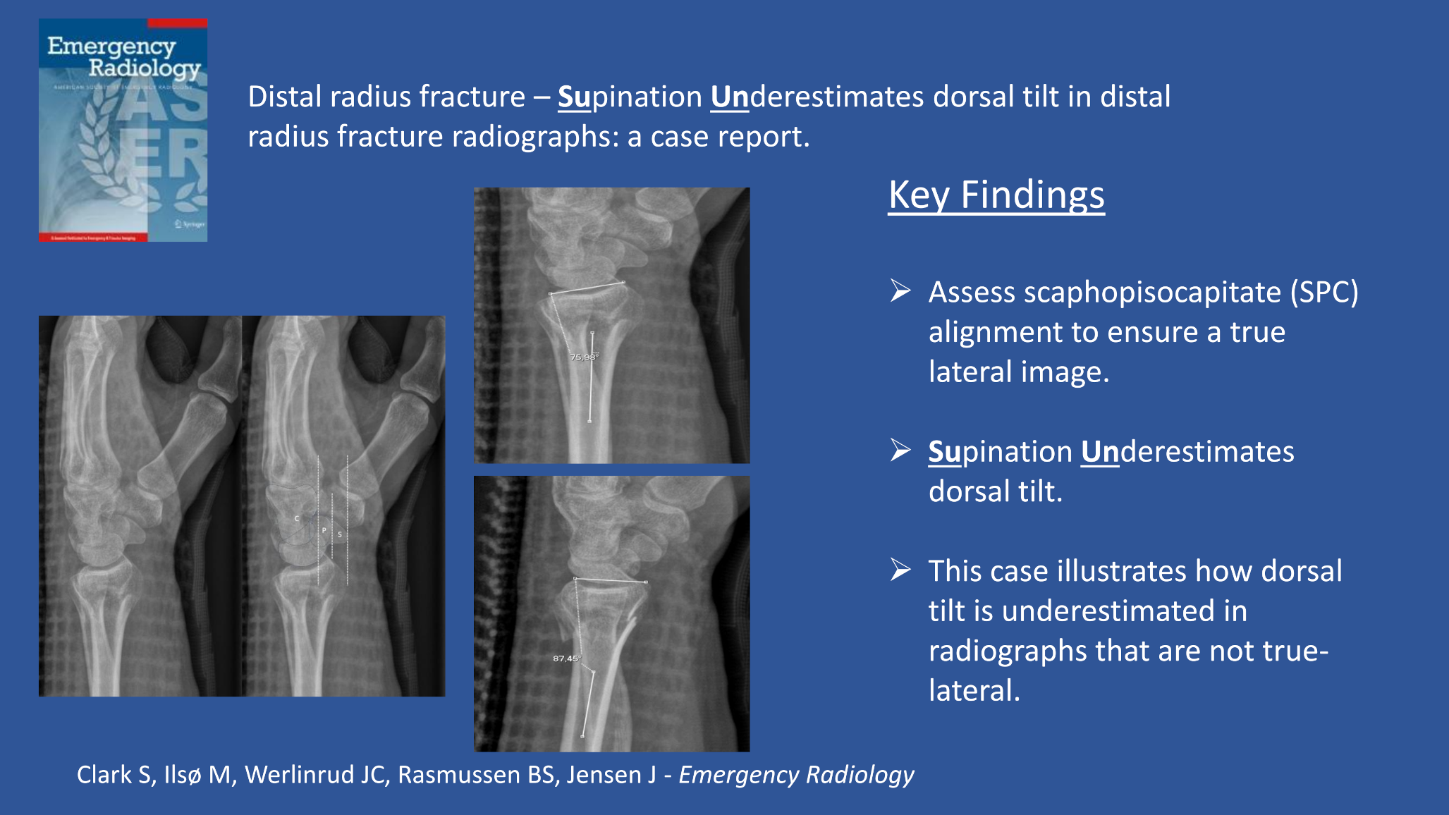 Distal radius fracture – Supination underestimates dorsal tilt in distal radius fracture radiographs: a case report