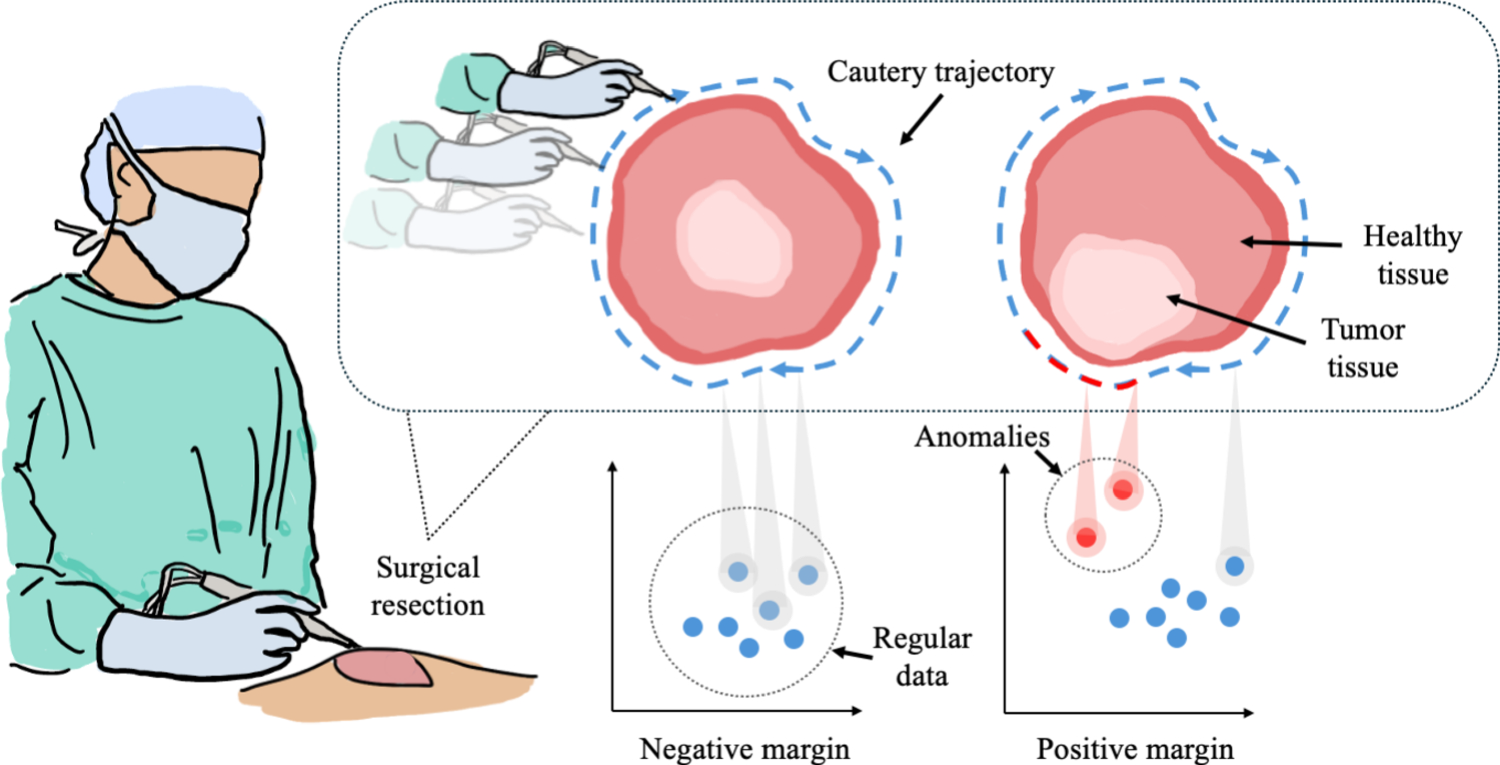 Anomaly detection using intraoperative iKnife data: a comparative analysis in breast cancer surgery