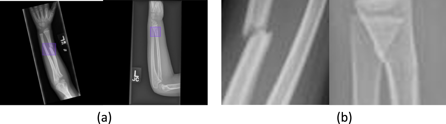 Analyzing pediatric forearm X-rays for fracture analysis using machine learning