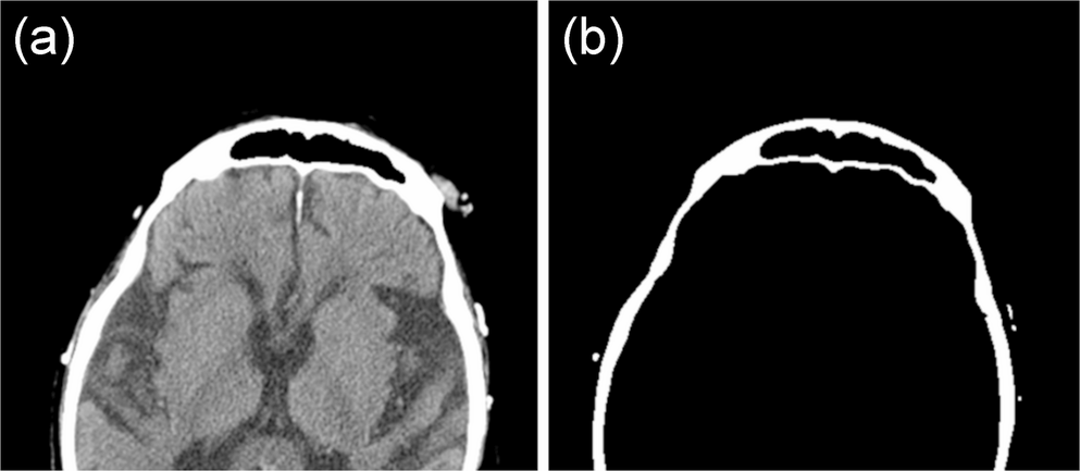 Forensic personal identification using two-dimensional computed tomographic imaging of the frontal sinus: a comparative analysis of feature matching algorithms
