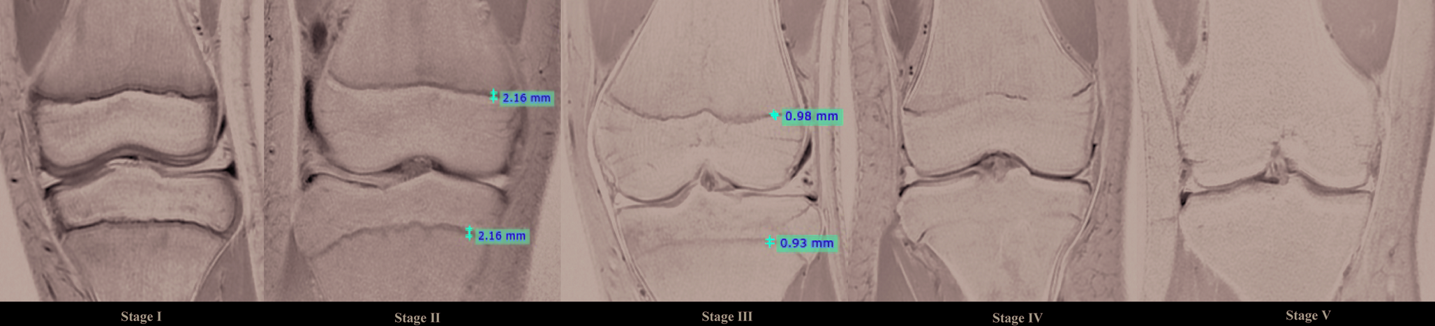Forensic age estimation using Dedouit classification in adolescents of the Southwestern Chinese Han population based on the knee MRI