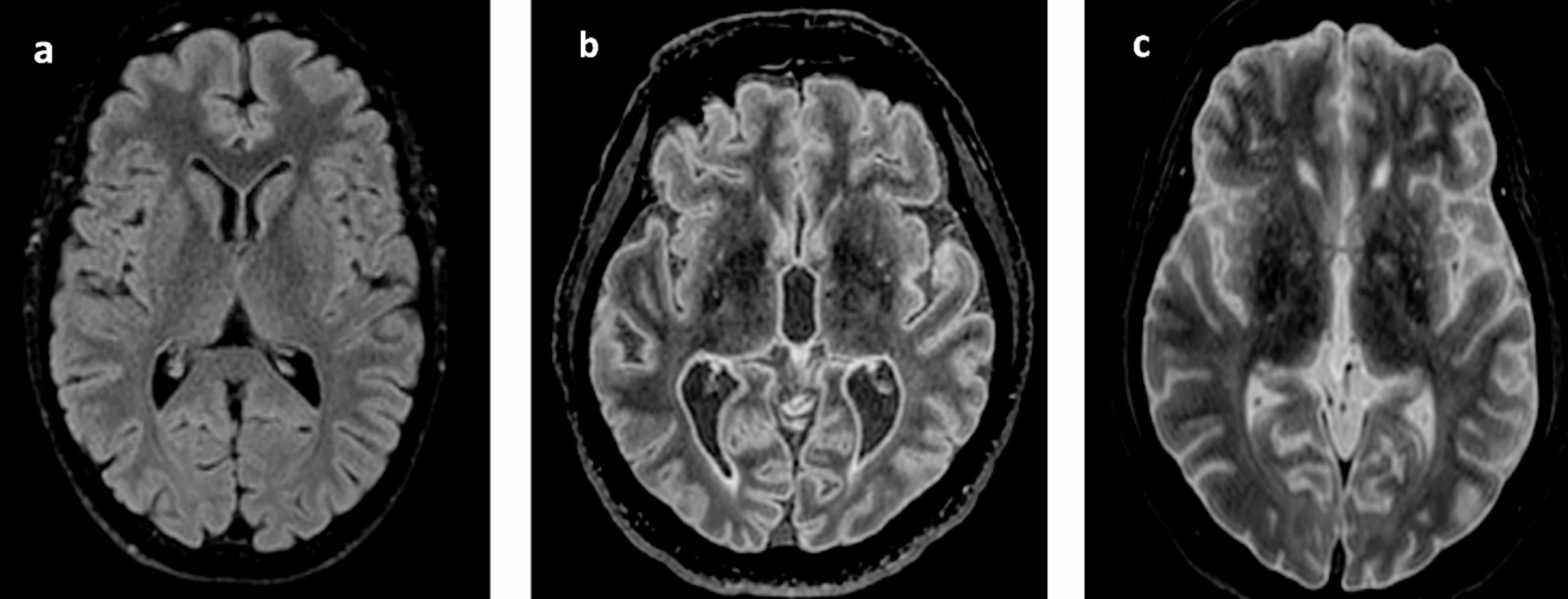 Inversion time optimization in postmortem 1.5 tesla FLAIR brain imaging: a pilot study
