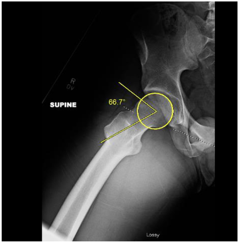 Sex-Based Differences Femoroacetabular Impingement and Hip Arthroscopy
