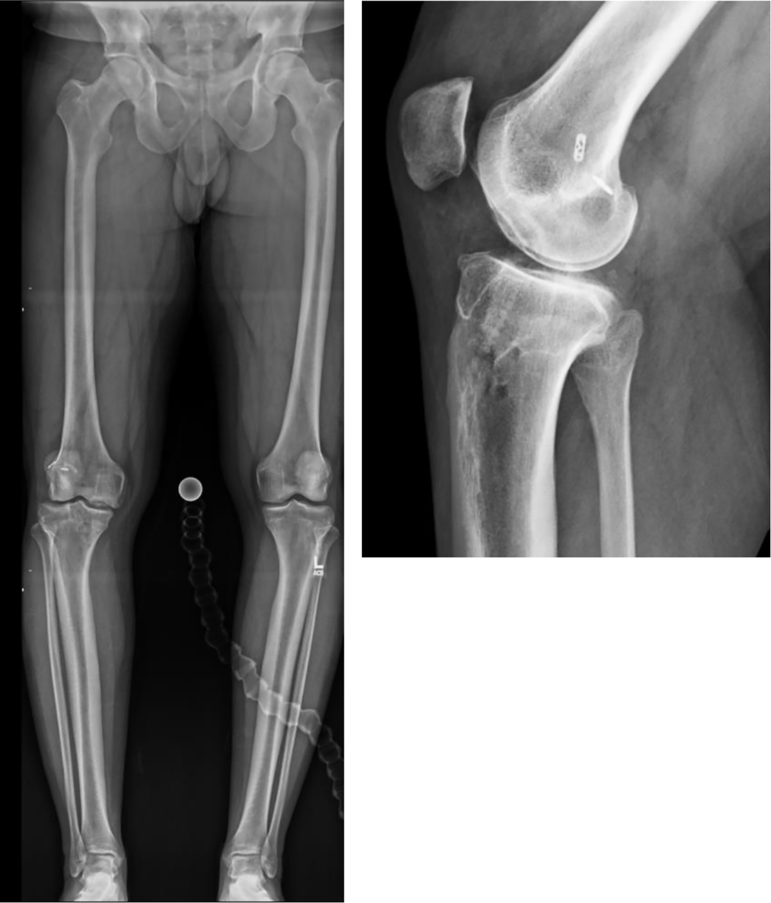 Indications, Technique, and Outcomes of Patient Specific Instrumentation for Osteotomy About the Knee