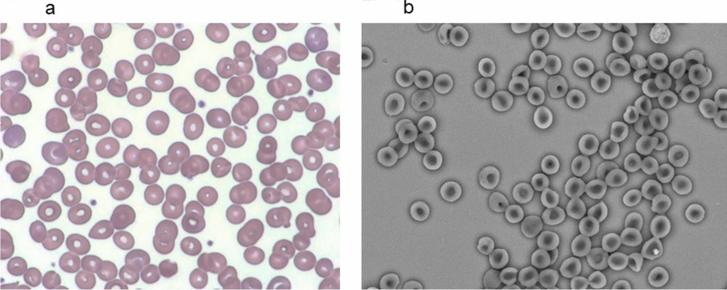 Acute hemolytic crises and clinical course in a Japanese family with Hb Santander: a detailed case report