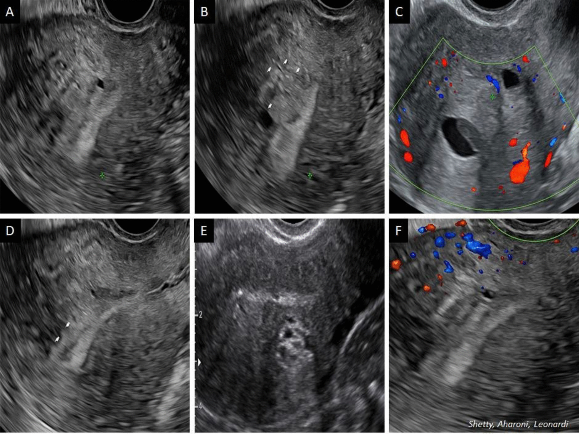 The Role of Ultrasound in the Evolving Landscape of Precision Imaging of Endometriosis