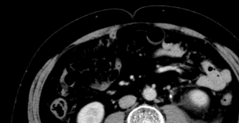 Spontaneous Ureteric Rupture Following Recent Chikungunya Virus Infection: Coincidence or Complication?