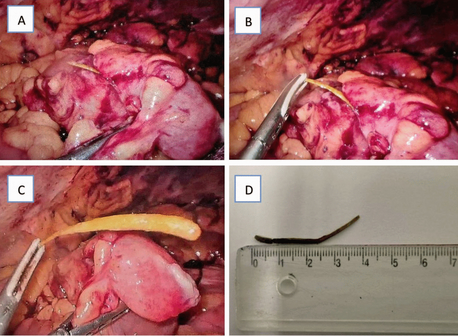 Hidden Toothpick in Meckel's Diverticulum—Clinical Mimicry of Acute Appendicitis